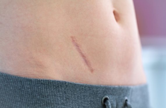 Narbe am Bauch nach einer Blinddarm-Operation