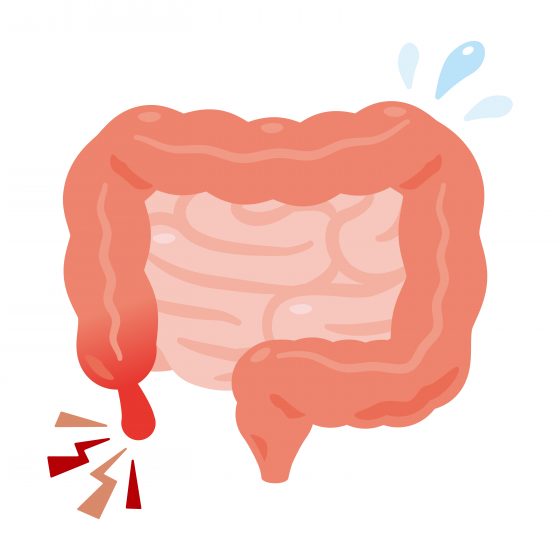 Illustration eines Darms mit Blinddarmentzündung