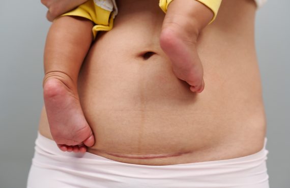 Bauch einer Frau mit Kaiserschnittnarbe des Kaiserschnitts. Mutter hält ihr Baby.