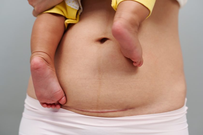 Bauch einer Frau mit Kaiserschnittnarbe des Kaiserschnitts. Mutter hält ihr Baby.